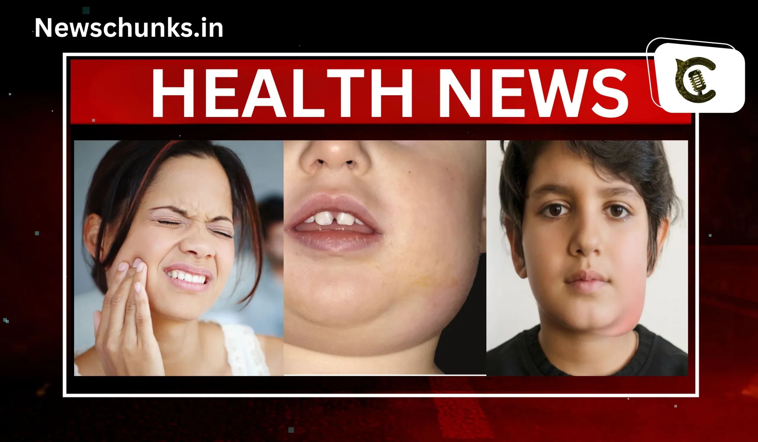 Kya Hain Mumps: क्या है Mumps? केरल में तेजी से फैल रही ये बीमारी, जानें लक्षण और बचाव