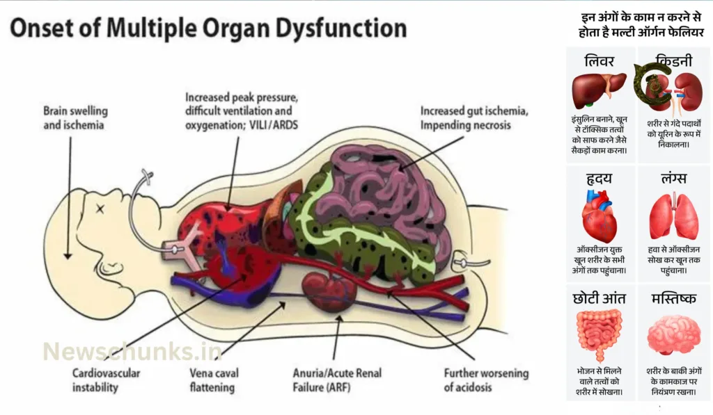 What is the Multiple Organ Failure?: क्या है मल्टीपल ऑर्गन फेलियर? जानें क्या हैं इस खतरनाक बीमारी के कारण, लक्षण और बचाव के उपाय