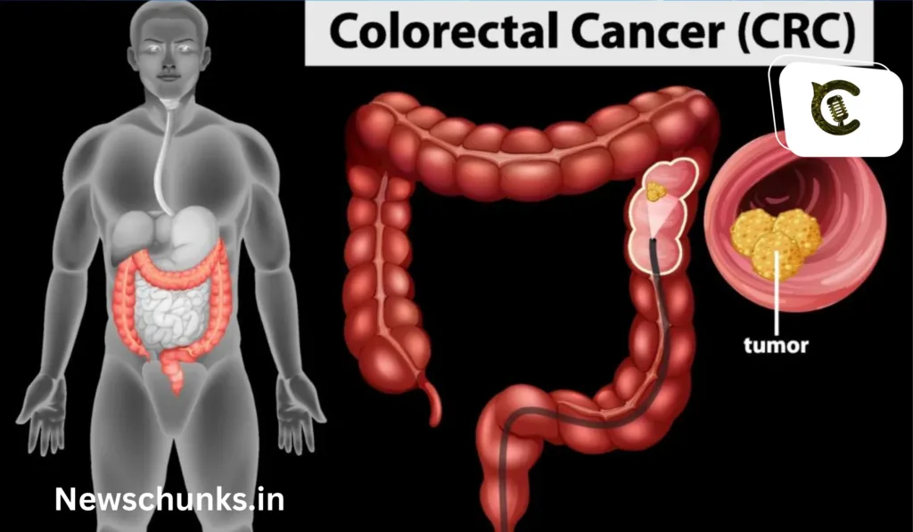 Causes symptoms and treatment of colon cancer: कोलन कैंसर के कारण, लक्षण और इलाज
