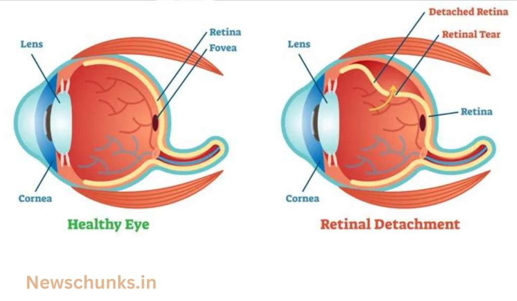 What is Retinal Detachment Causes and Symptoms: क्या है Retinal Detachment? जिसकी सर्जरी के लिए ब्रिटेन जाएंगे AAP सांसद Raghav Chadha